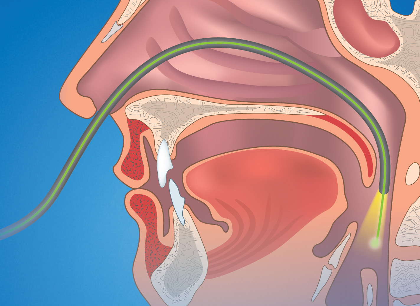 mhxanhma diodiko laser nuvolas-characteristics