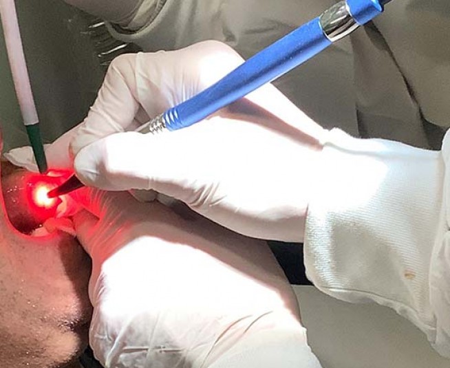 FireLas Blue στη χειρουργική μαλακών ιστών στην Οδοντιατρική