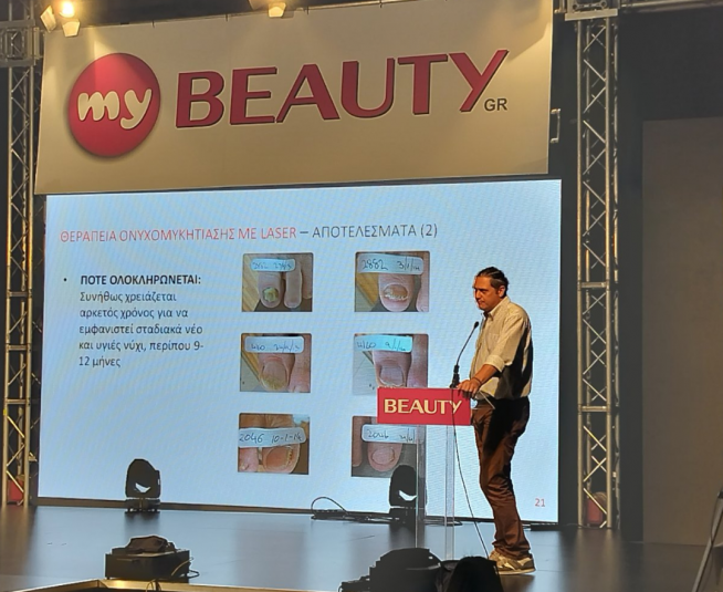 BEAUTY 2023: Θεραπεία LASER για την Ονυχομυκητίαση