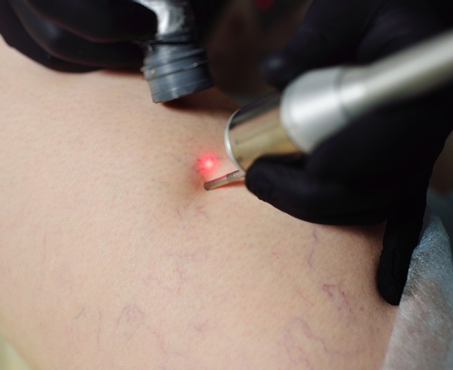 Αντιμετώπιση Αγγειακών Βλαβών με LASER