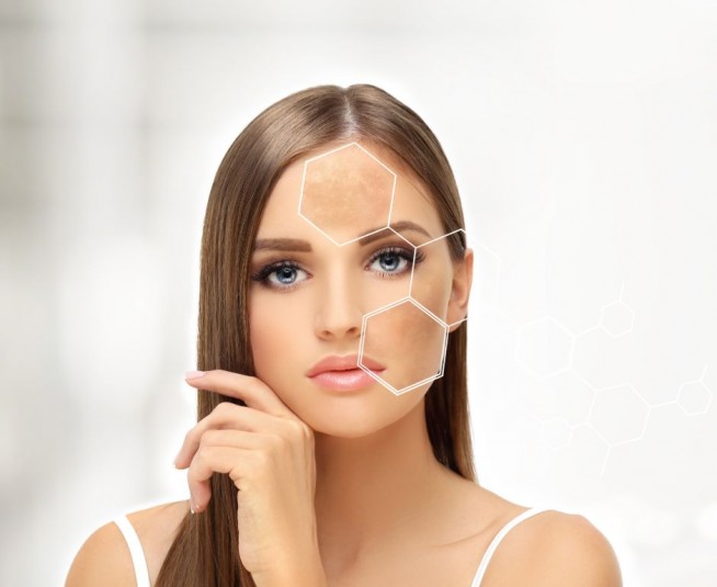 Η μελάχρωση πλέον αντιμετωπίζεται με LASER