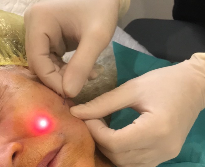 LASER F.A.S.T.: Σύσφιξη Δέρματος με Οπτική ίνα LASER